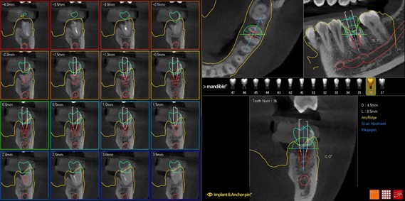 Цифровой протокол планирования дентальной имплантации5.jpg