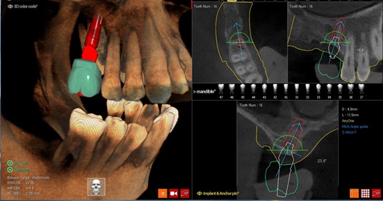 Цифровой протокол планирования дентальной имплантации4.jpg