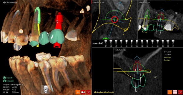 Цифровой протокол планирования дентальной имплантации1.jpg