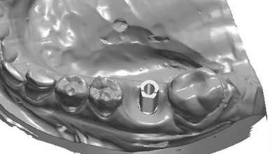 Цифровой протокол планирования дентальной имплантации6.jpg