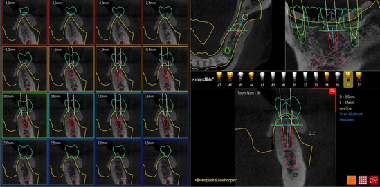 Цифровой протокол планирования дентальной имплантации3.jpg
