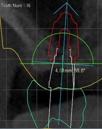 Цифровой протокол планирования дентальной имплантации2.jpg
