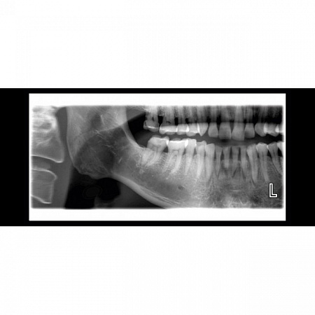 Planmeca ProOne - универсальный цифровой ортопантомограф